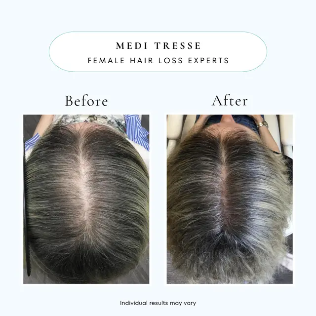 Medi Tresse