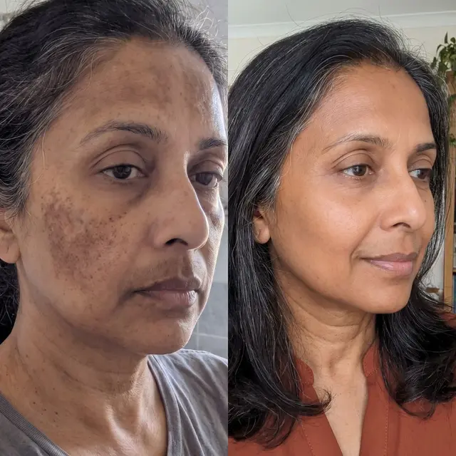 Jyoti's Skincare Journey